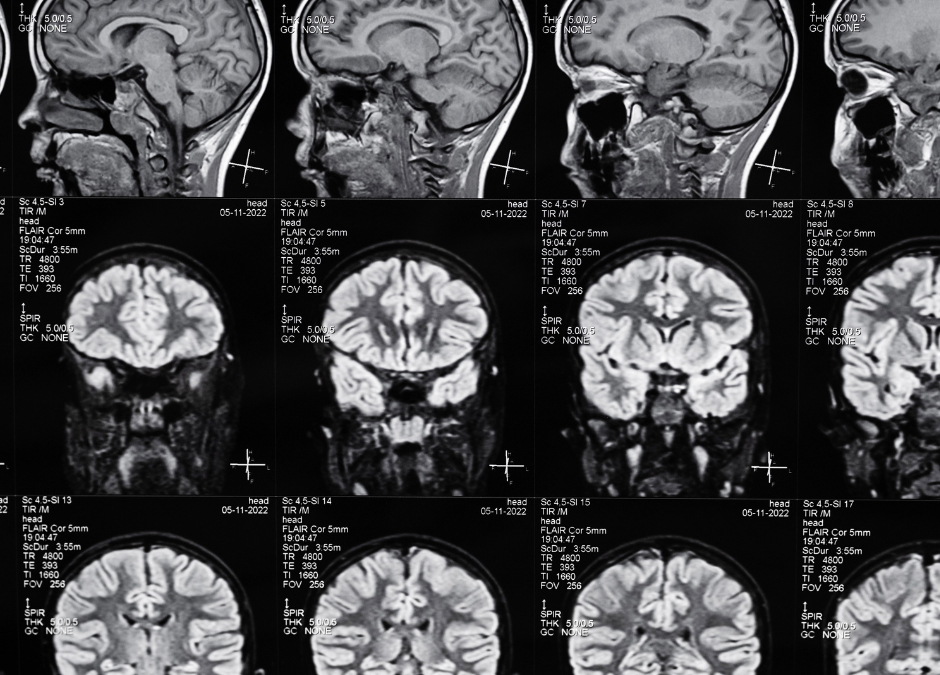 Why Do Traumatic Brain Injuries in Alabama Demand Local Legal Expertise?